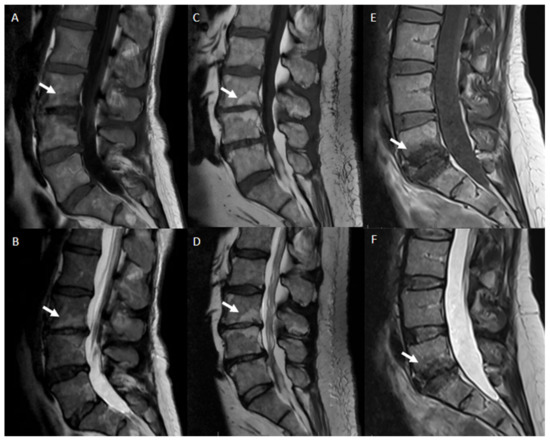 Degenerative Disc Disease of the Spine: From Anatomy to