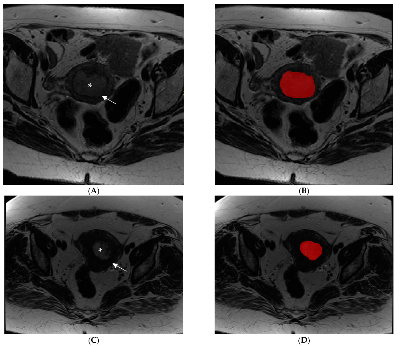 JPM | Free Full-Text | Preoperative Tumor Texture Analysis on MRI for High-Risk Disease in Endometrial A Hypothesis-Generating Study