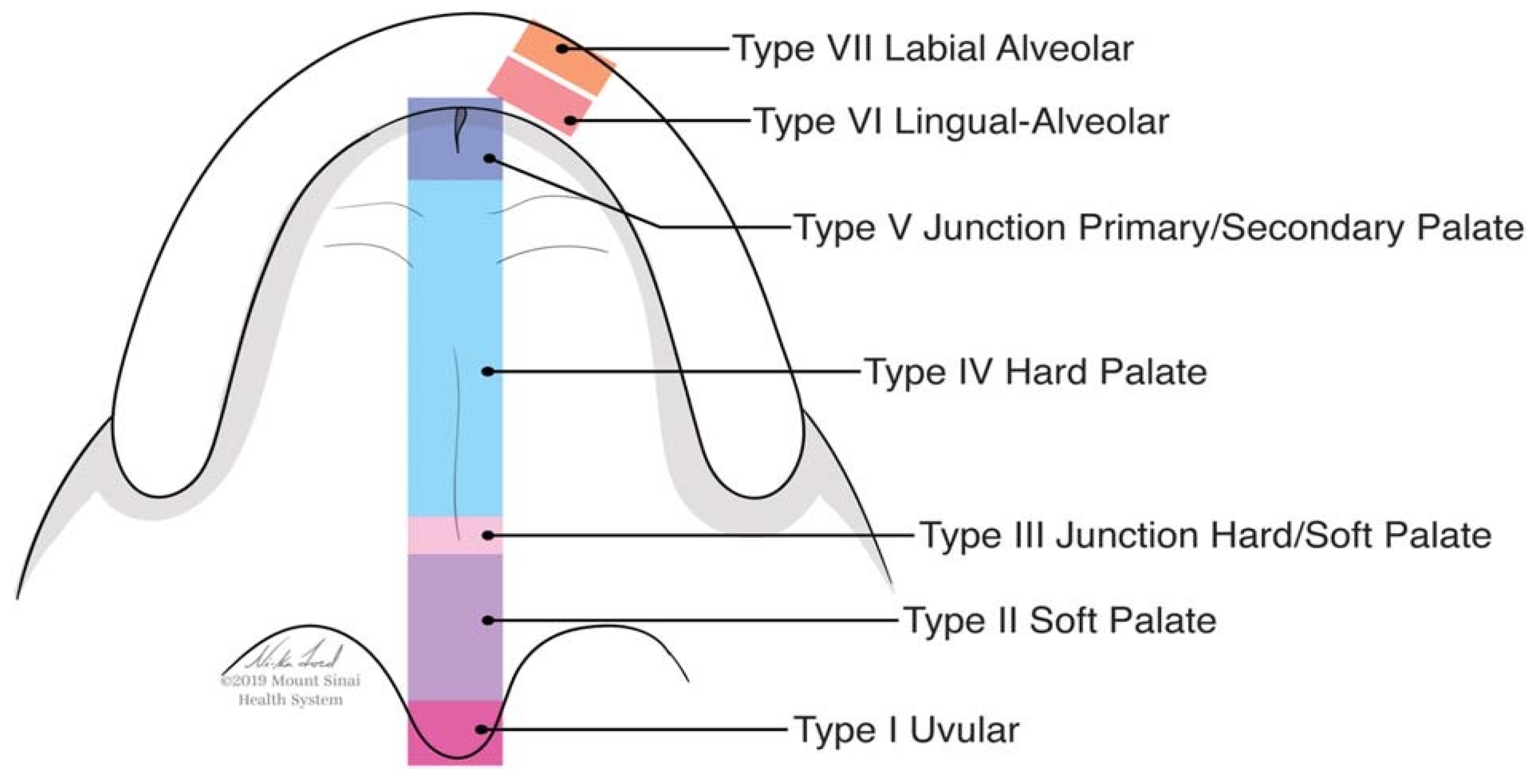 JPM Free FullText Evaluation of a Novel Technique for Closure of Small Palatal Fistula