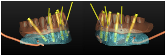 Computer-Aided Design and Computer-Aided Modeling (CAD/CAM) for Guiding ...
