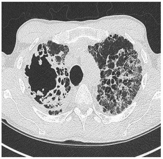 Signet ring sign (bronchiectasis) | Radiology Reference Article |  Radiopaedia.org