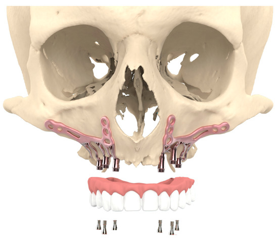 Patient Satisfaction and Impact on Oral Health after Maxillary
