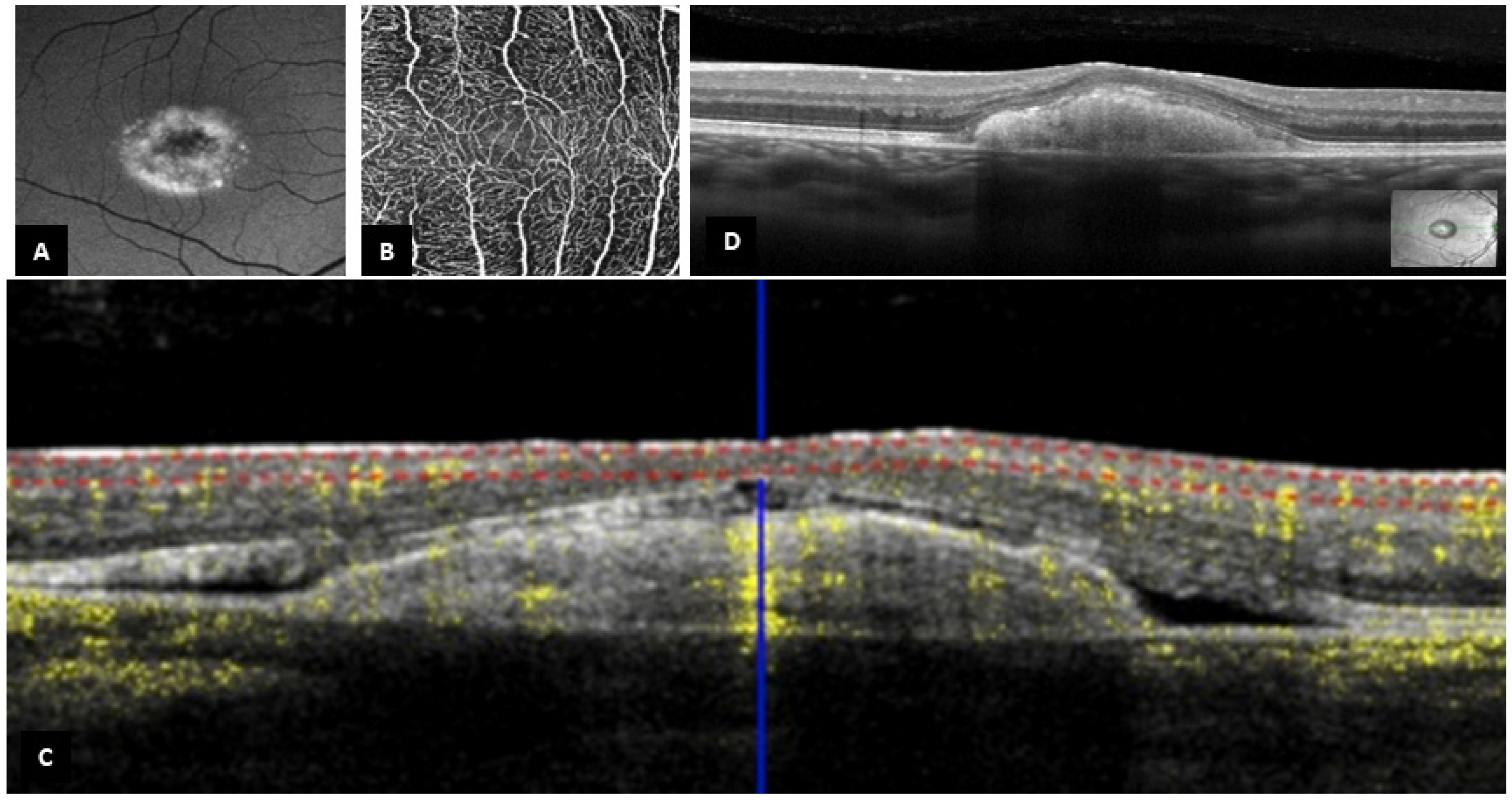 JPM | Free Full-Text | Atypical Foveal Hypoplasia in Best Disease