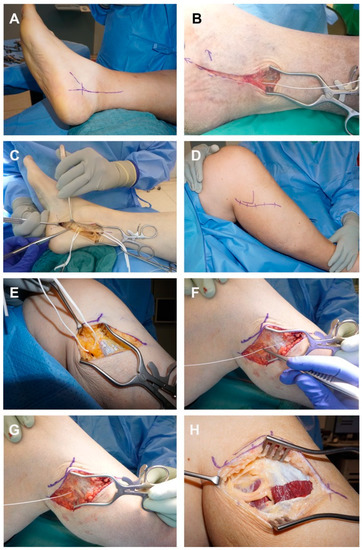 Effect of Surgical Release of Entrapped Peripheral Nerves in 