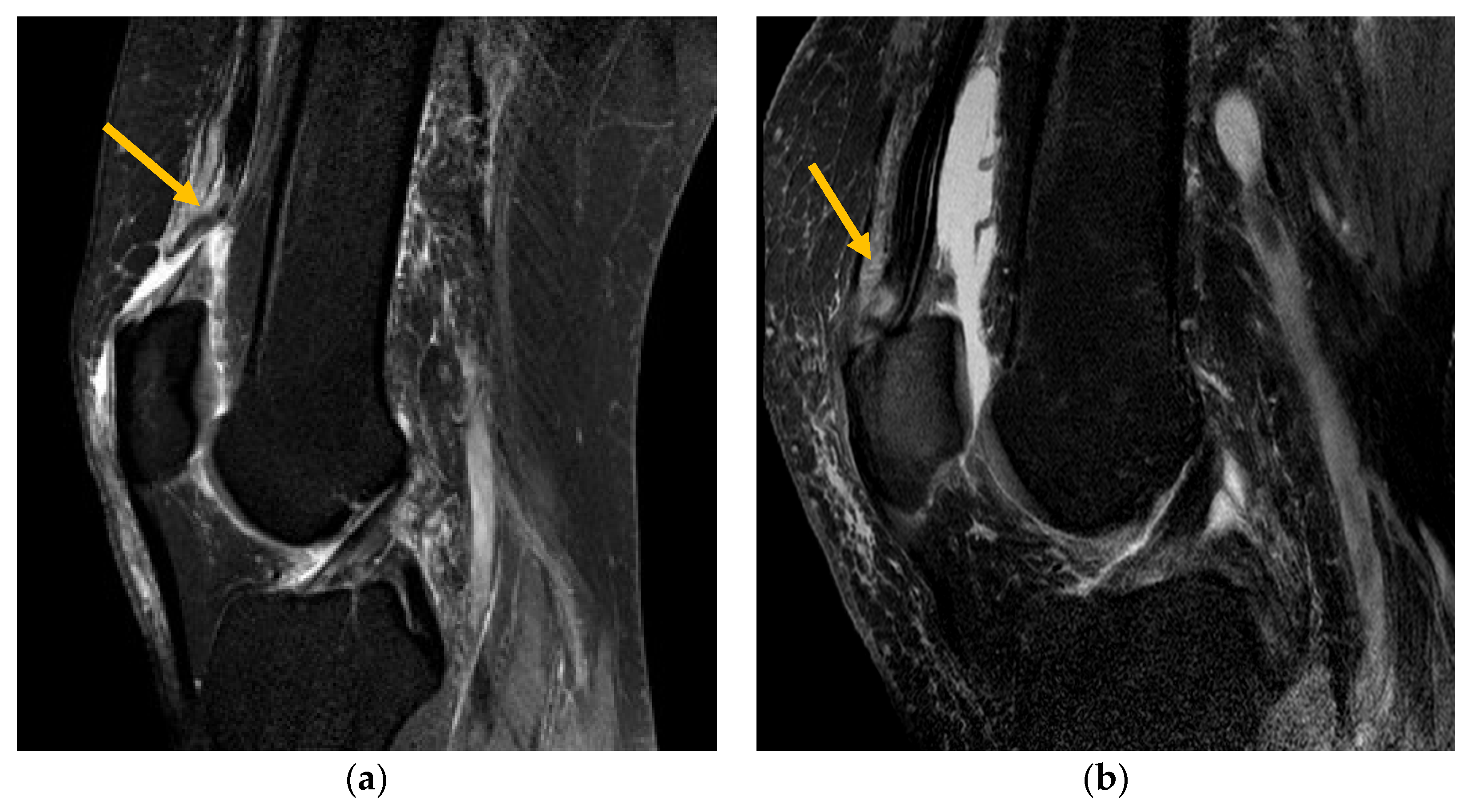 Quadriceps tendinopathy