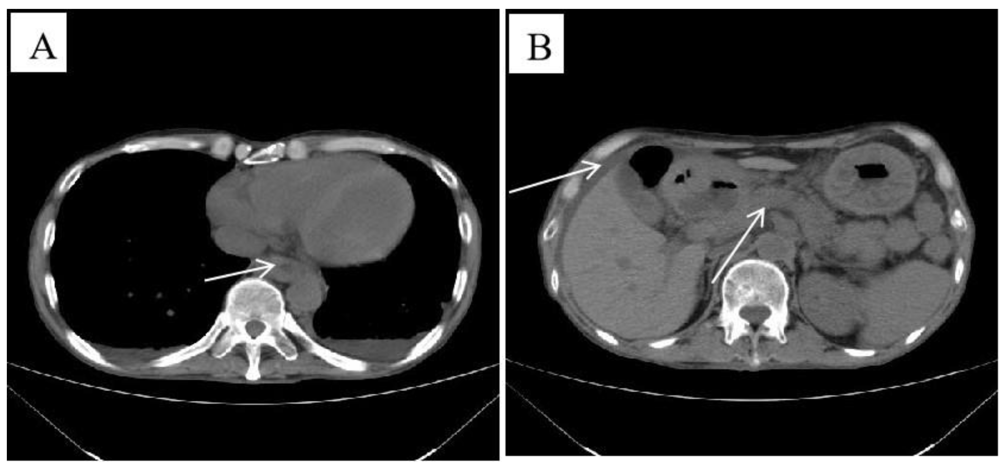 JPM Free Full-Text IgG4-Related Oesophageal Disease with Cytomegalovirus Infection A Case Report