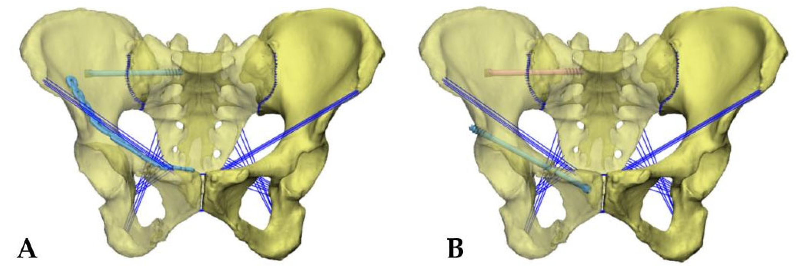 Consultant Teachings No. 5: Pelvic Ring and Acetabular Injuries for the  Emergency Provider — WashU EM Blog