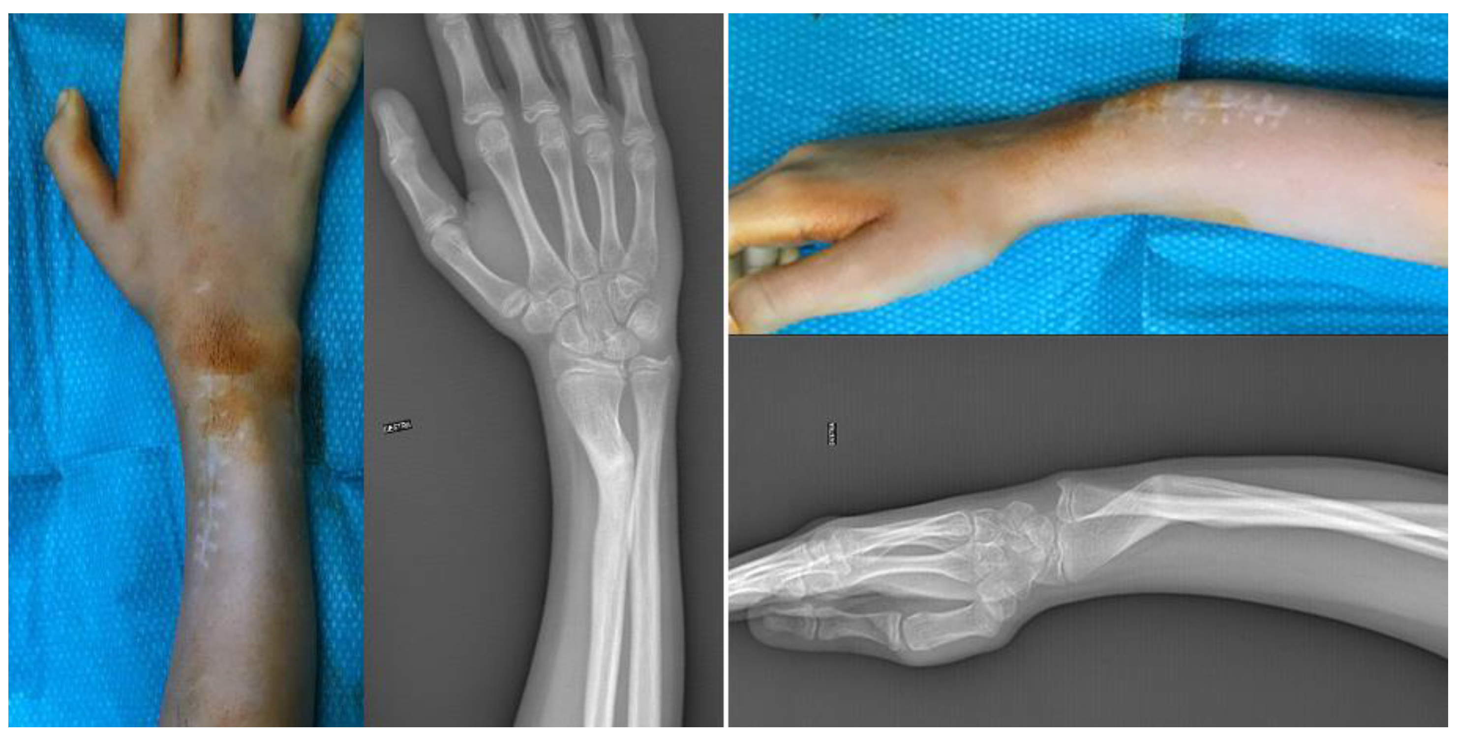 JPM Free Full Text The Flipping Wedge Osteotomy How 3D