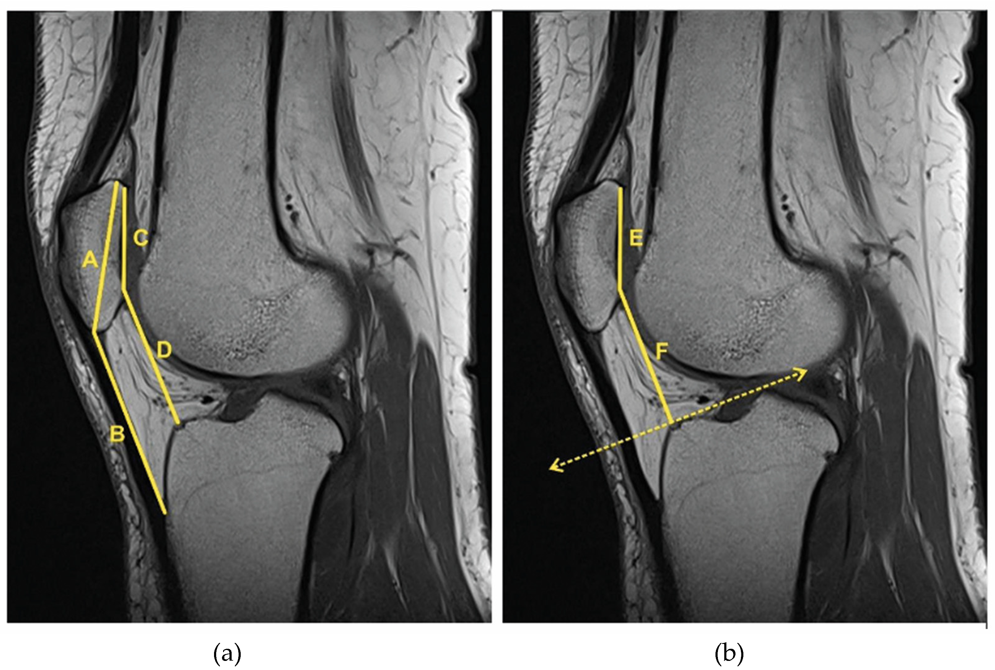 Patellar Tendon Palpation | Patellar Tendinopathy - YouTube