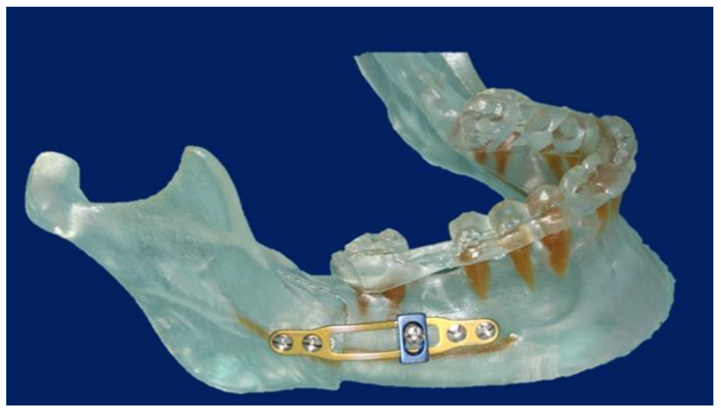 Dental Root Injuries Caused by Osteosynthesis Screws in