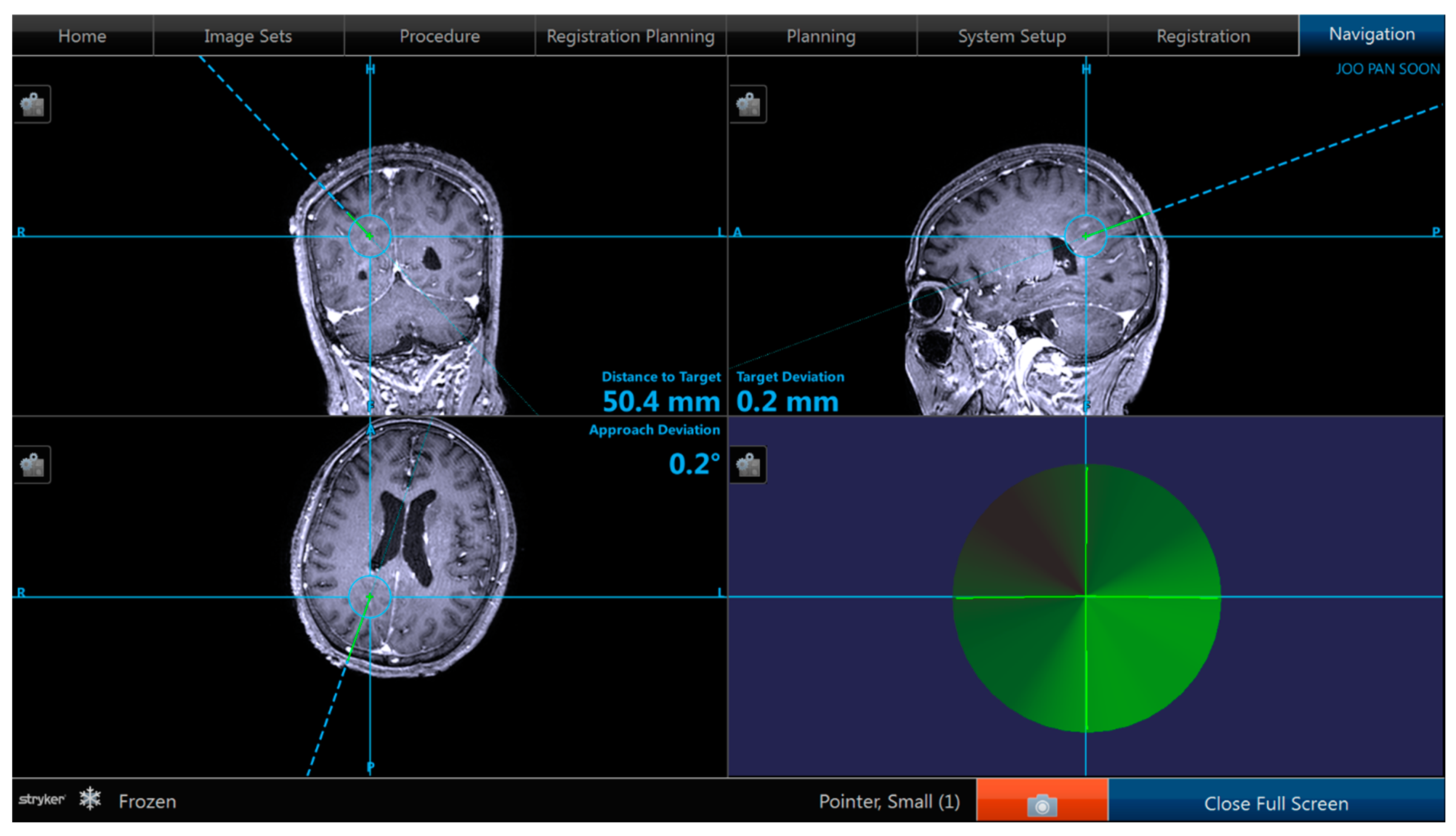 JPM Free FullText Navigation Guided Biopsy Is as Effective as