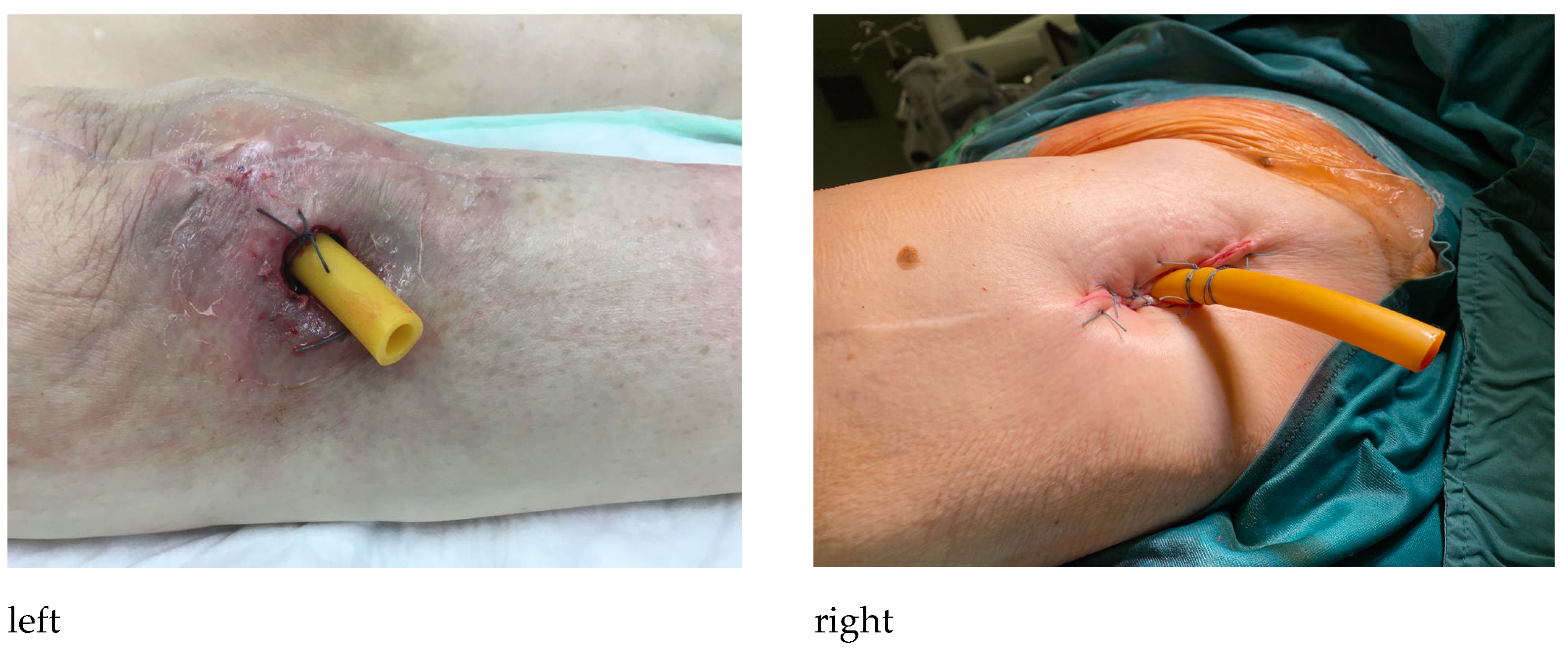 The Sinus Tract in Bone and Joint Infection: Minimally Invasive 
