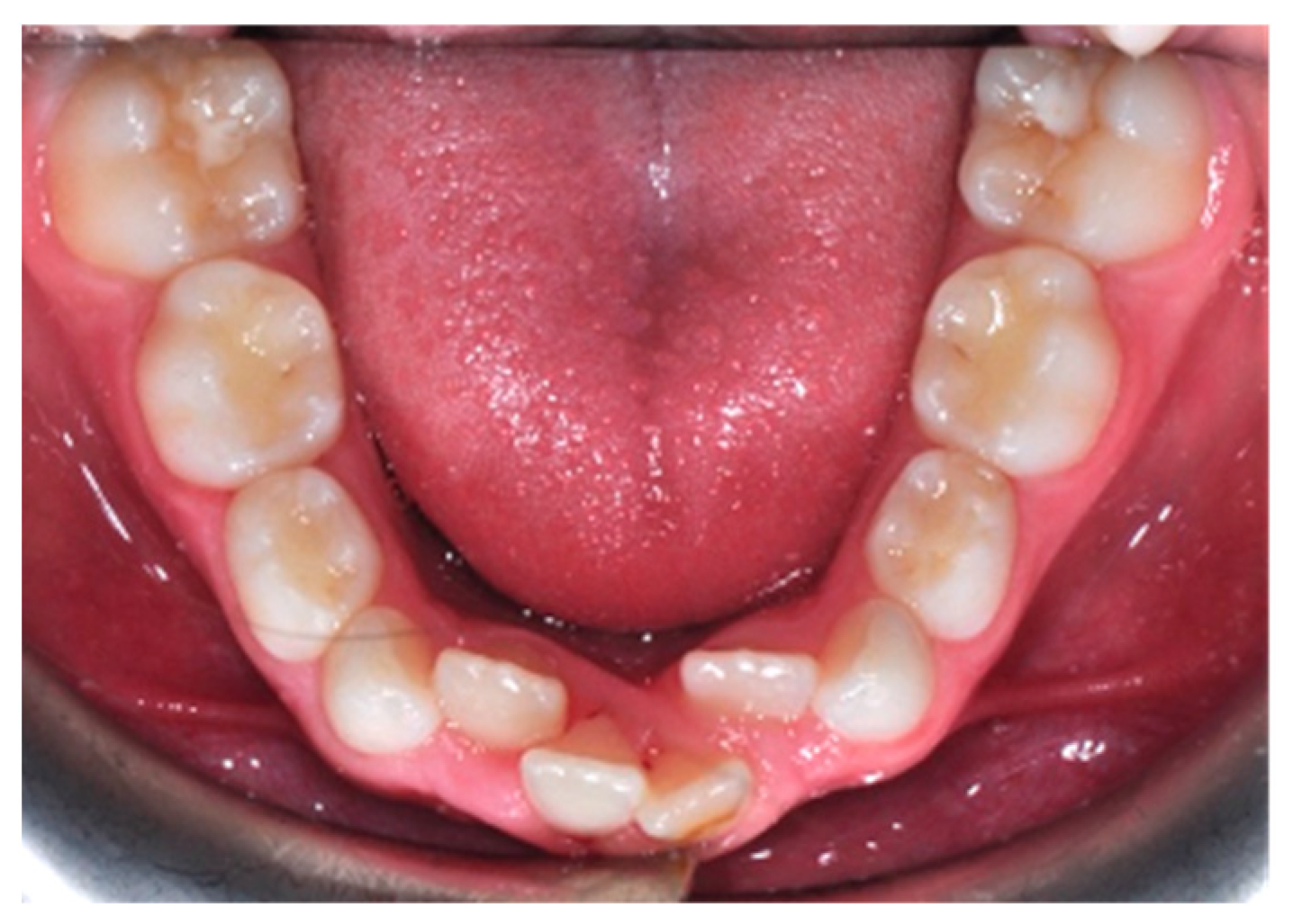 JPM Free Full Text Mandibular Crowding: Diagnosis and Management A JPM Free Full Text Mandibular Crowding: Diagnosis and Management A