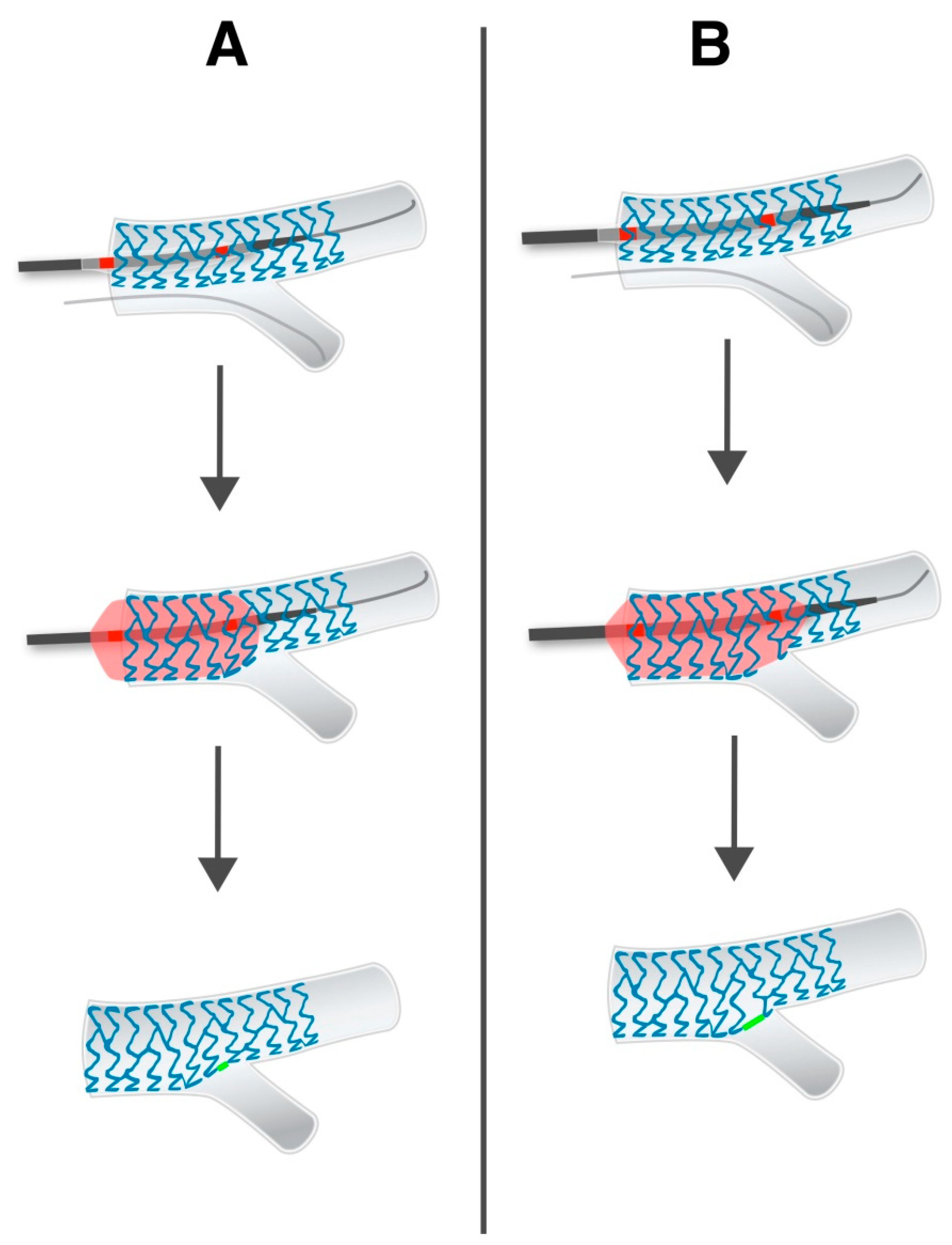 The Degree of Stent Apposition Measured by Stent Enhancement at the Level of the Side Branch as