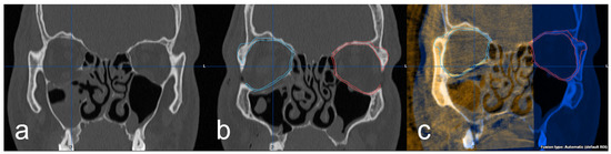 Comparison of Anatomical Preformed Titanium Implants and Patient ...