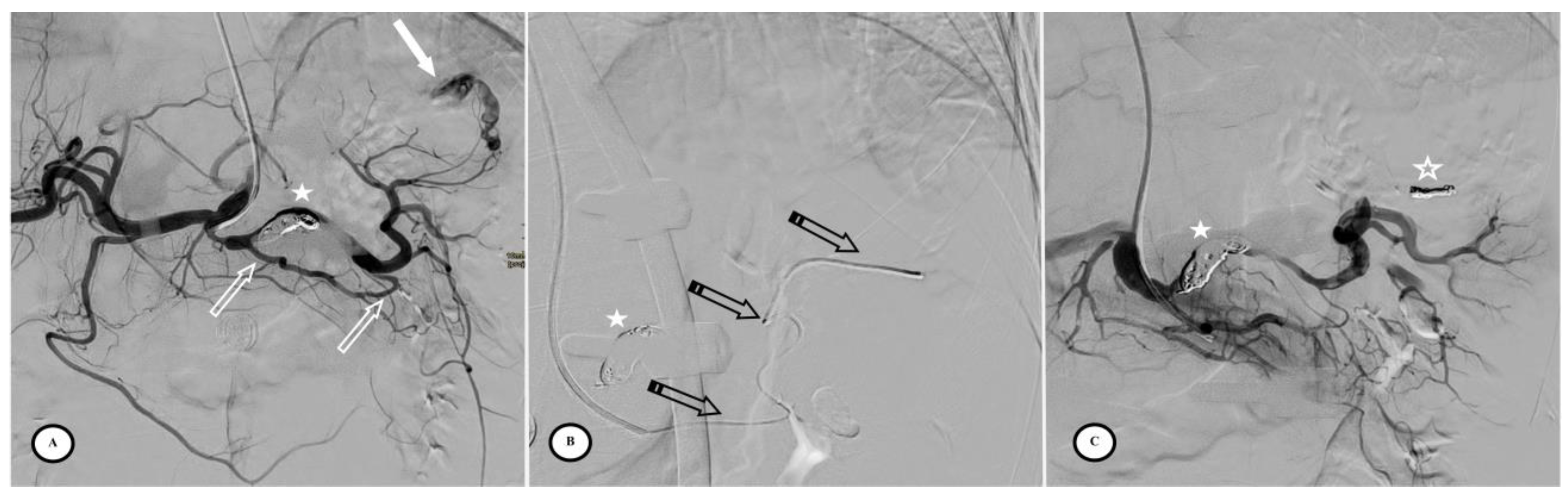 JPM Free FullText Preventive Proximal Splenic Artery Embolization