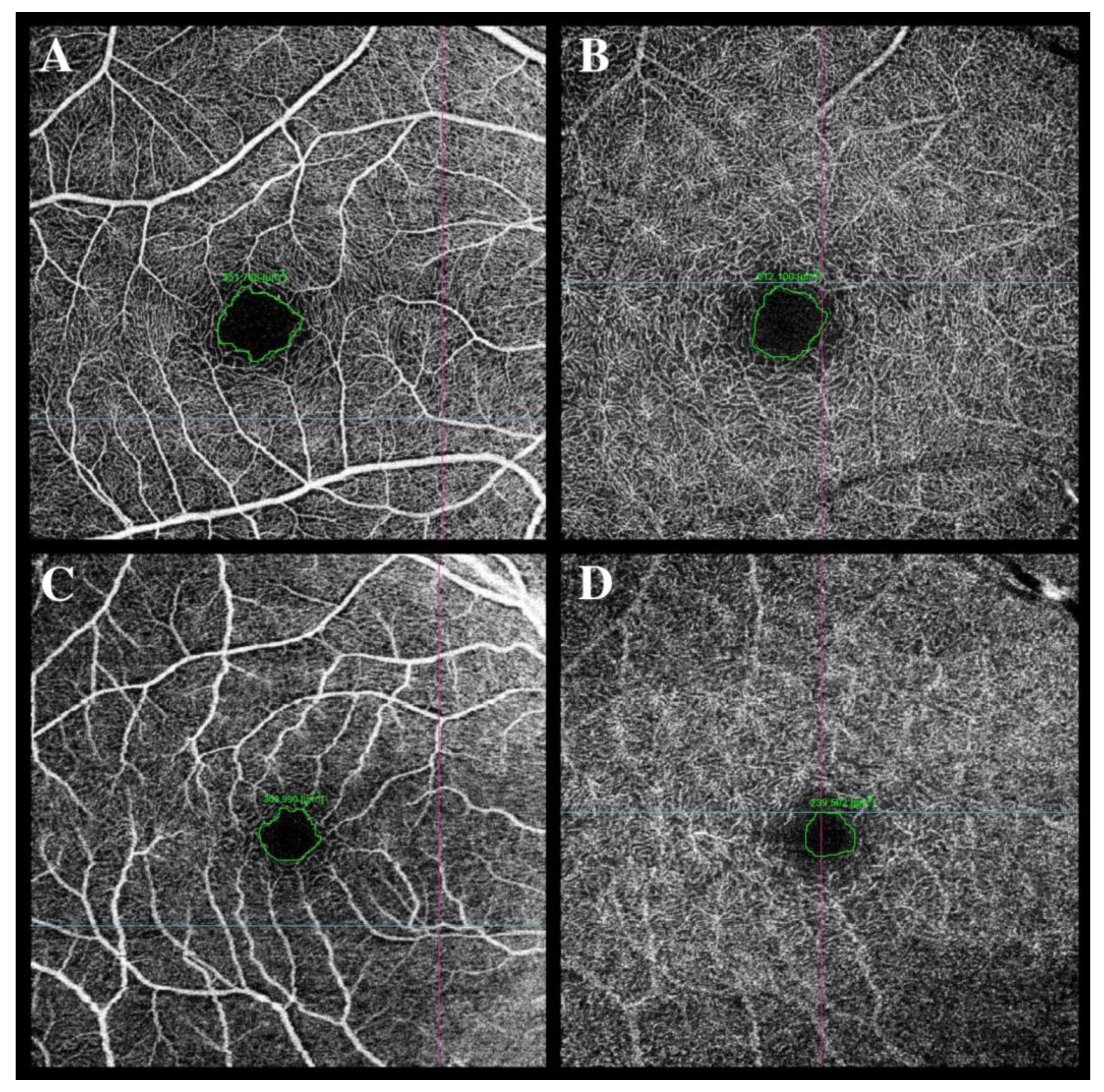 Reduced Vessel Density and Enlarged Foveal Avascular Zone in the Macula ...