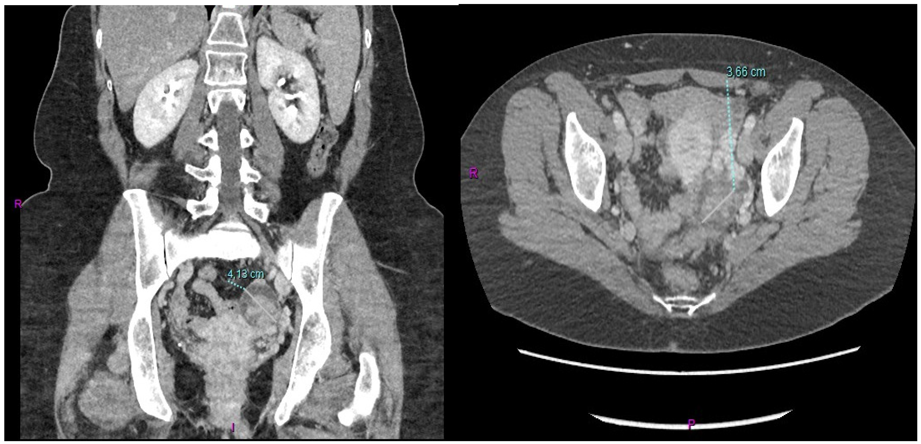Krukenberg Tumor Related to Gallbladder Cancer in a Young