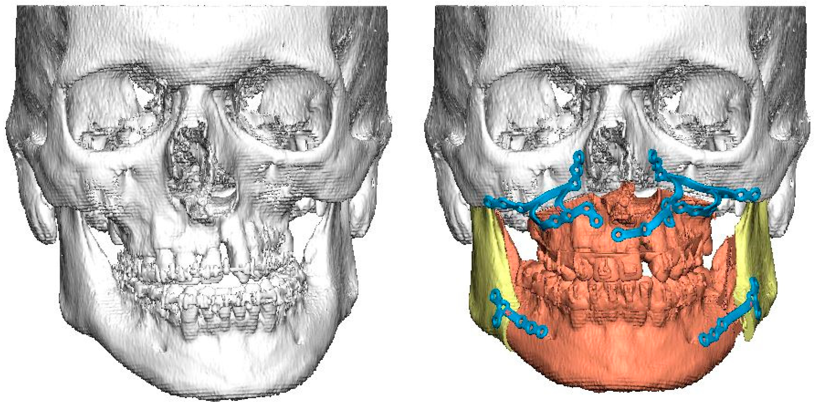 Unilateral Cleft Lip and Palate Has Asymmetry of Bony Orbits
