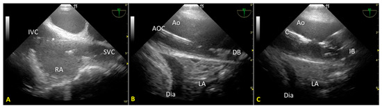 Transesophageal Echocardiography Guidance to Prevent and