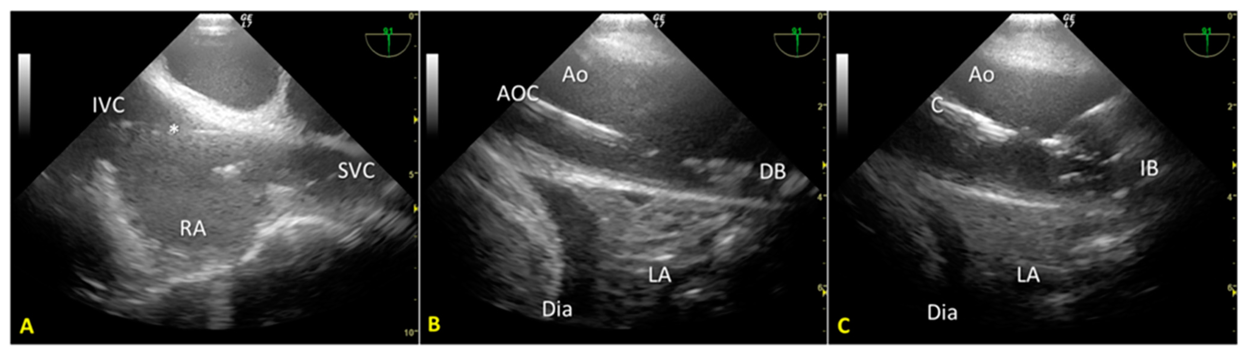 Transesophageal Echocardiogram  Amelia Heart & Vascular Center