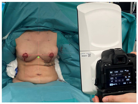 PDF] Breast Augmentation Virtual Surgery Using 3D Body Scanning Bridging  the Gap between Patient Expectations and Surgical Practicalities