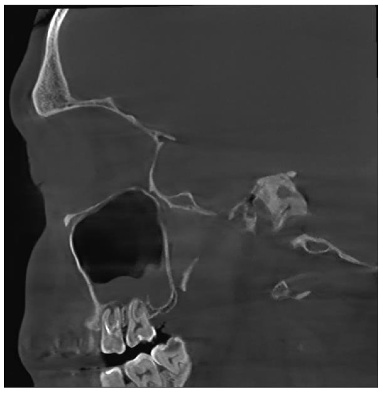 Odontogenic sinusitis clearance