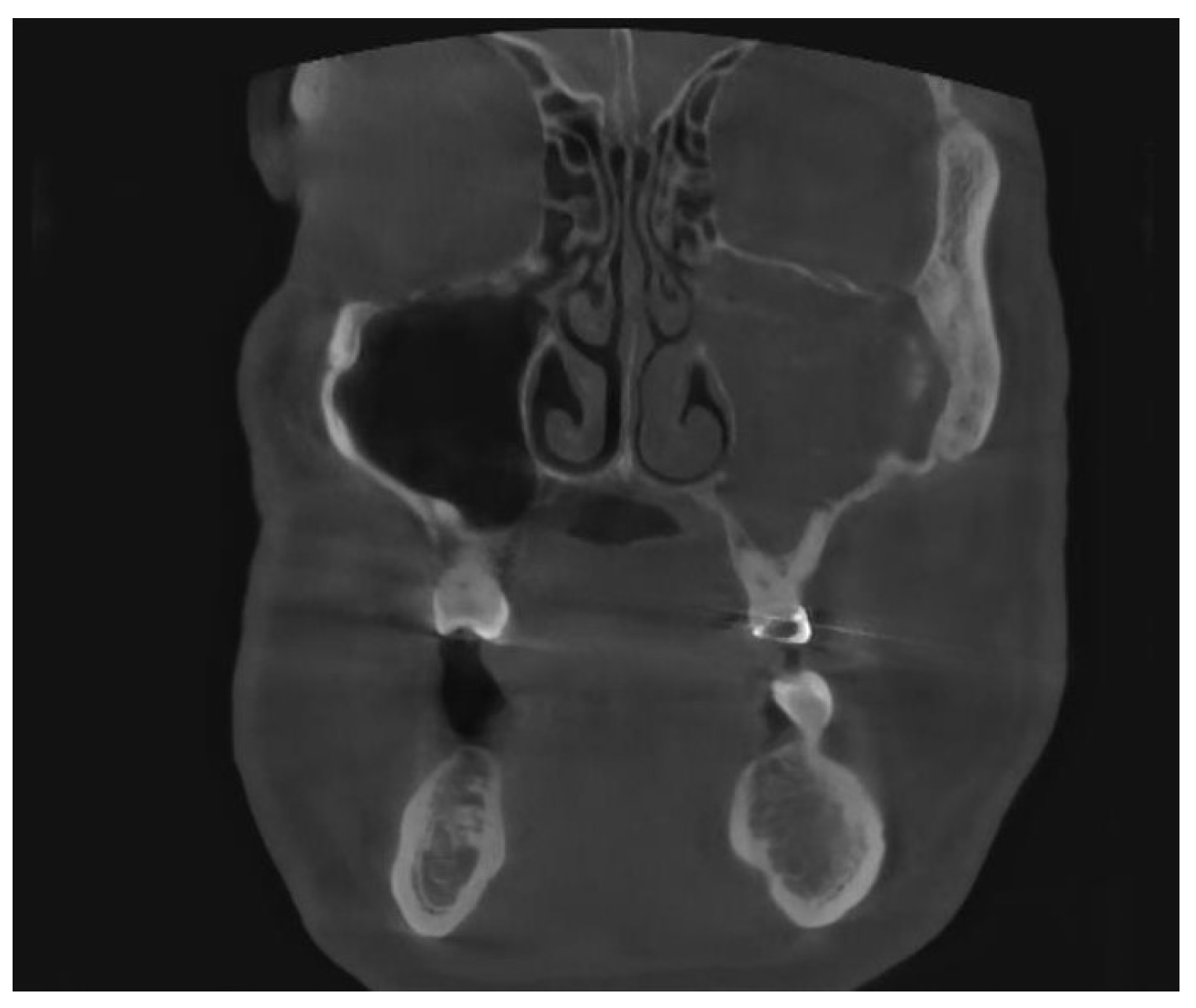 JPM Free FullText Management of Odontogenic Sinusitis Results