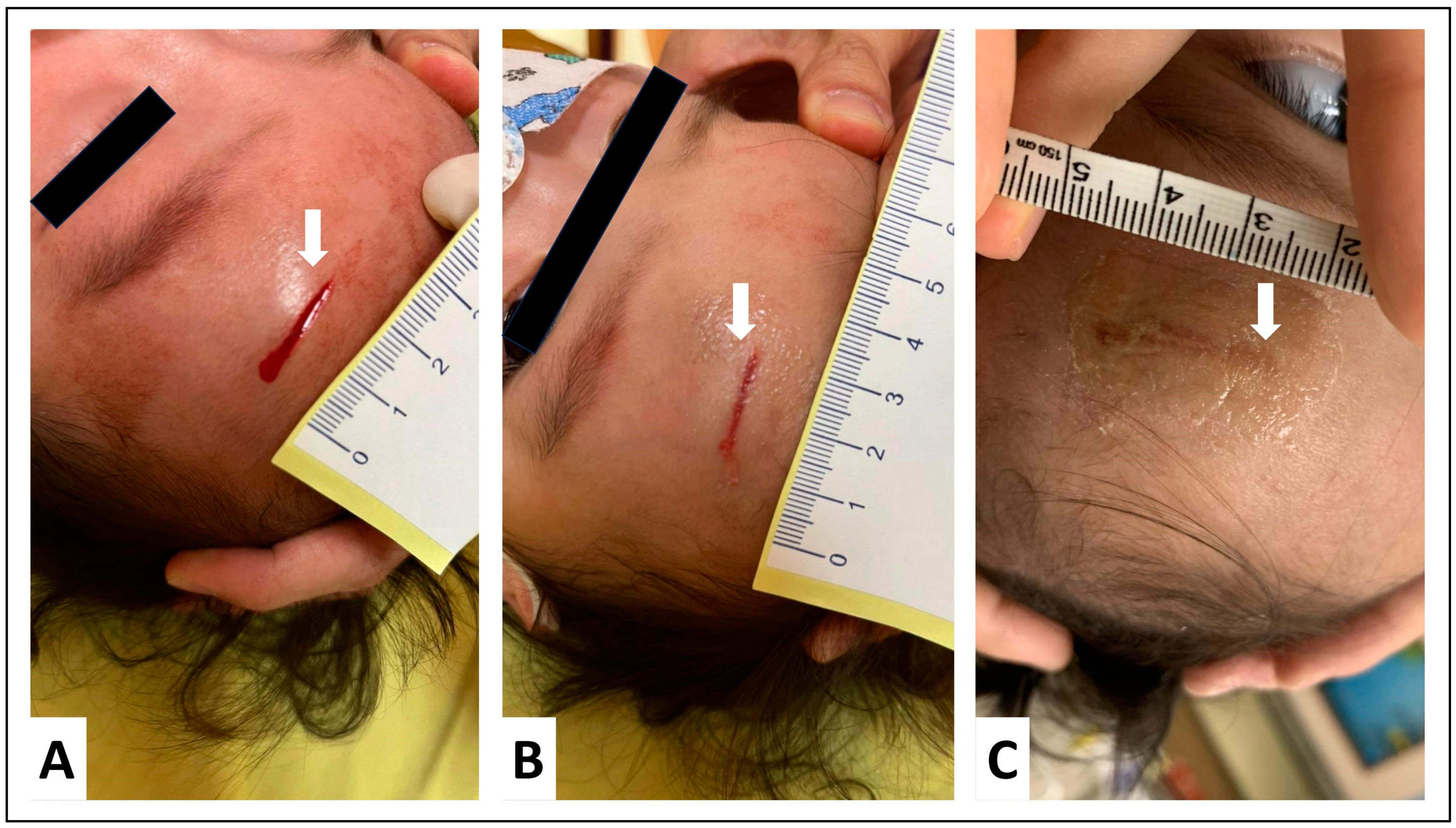 Morphological comparison of fibrin glue, CPAA glue, and suture in the