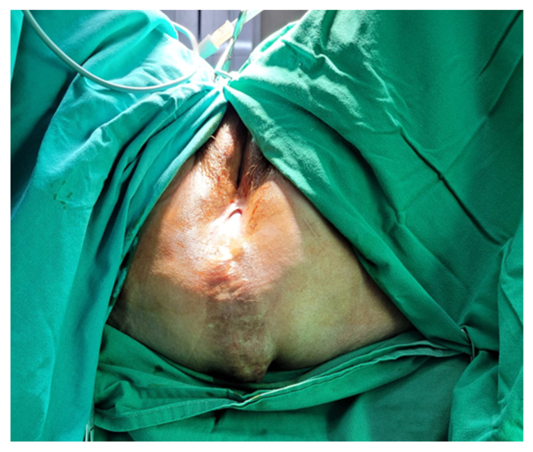 JPM | Free Full-Text | Perineal Hernia Mesh Repair Using Only the Perineal  Approach: How We Do It