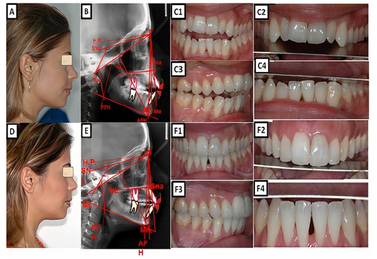 Narrating the Genetic Landscape of Human Class I Occlusion: A