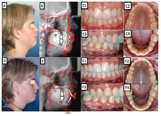 Narrating the Genetic Landscape of Human Class I Occlusion: A