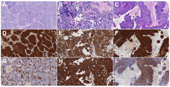 Sox2 and βIII-Tubulin as Biomarkers of Drug Resistance in