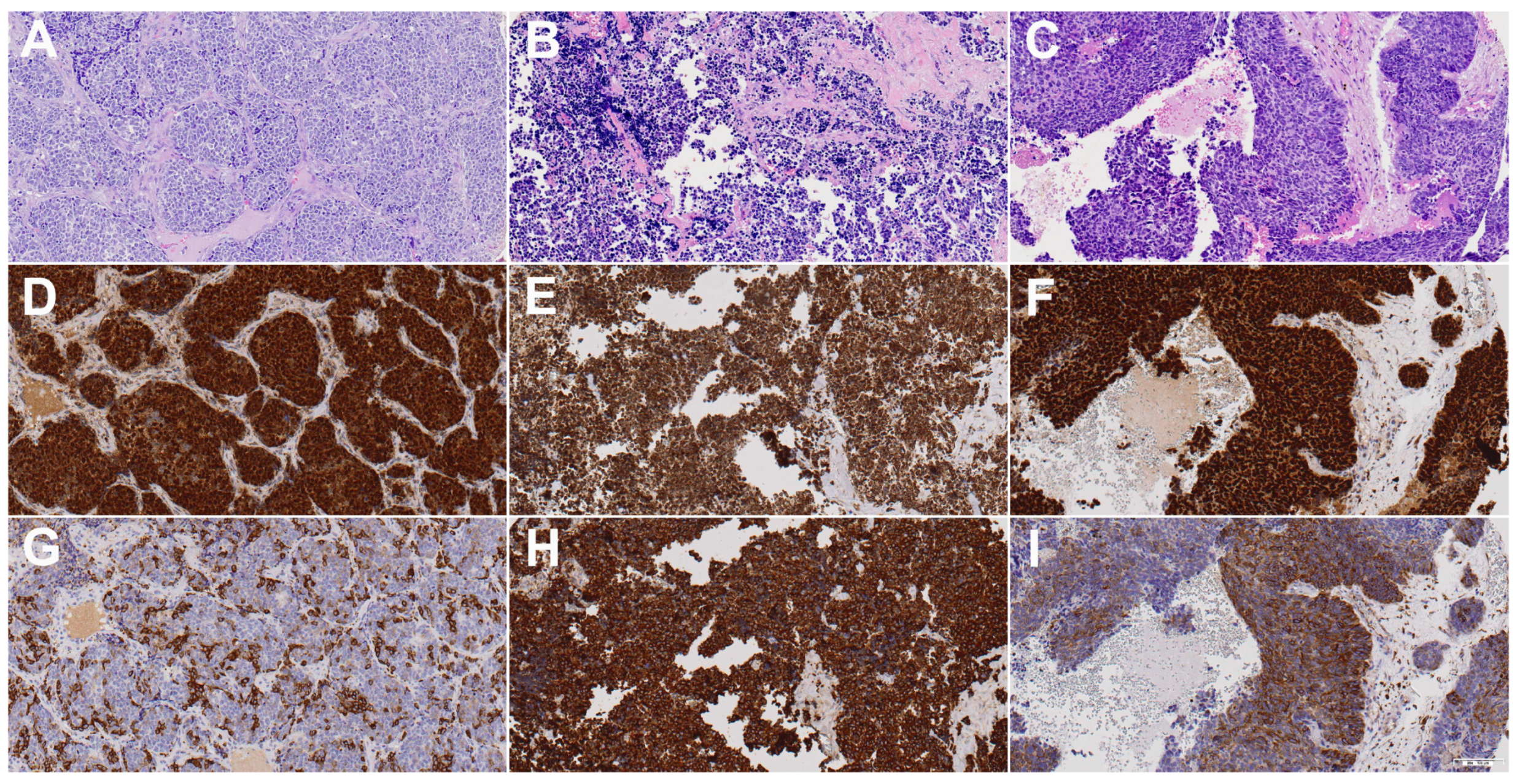 Sox2 and βIII-Tubulin as Biomarkers of Drug Resistance in Poorly  Differentiated Sinonasal Carcinomas