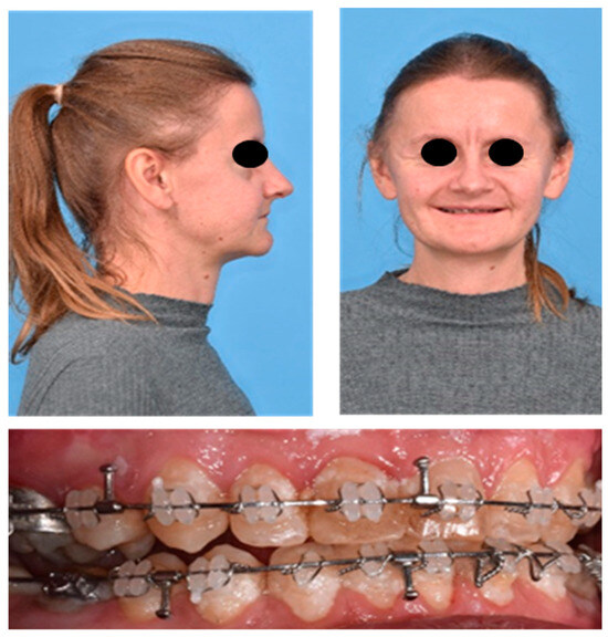 Orthognathic Surgery with Interdisciplinary Digital Planning in ...