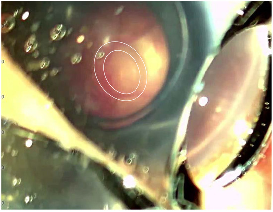ジェーナス　SP Aicardi–Goutières Syndrome with Congenital Glaucoma Caused