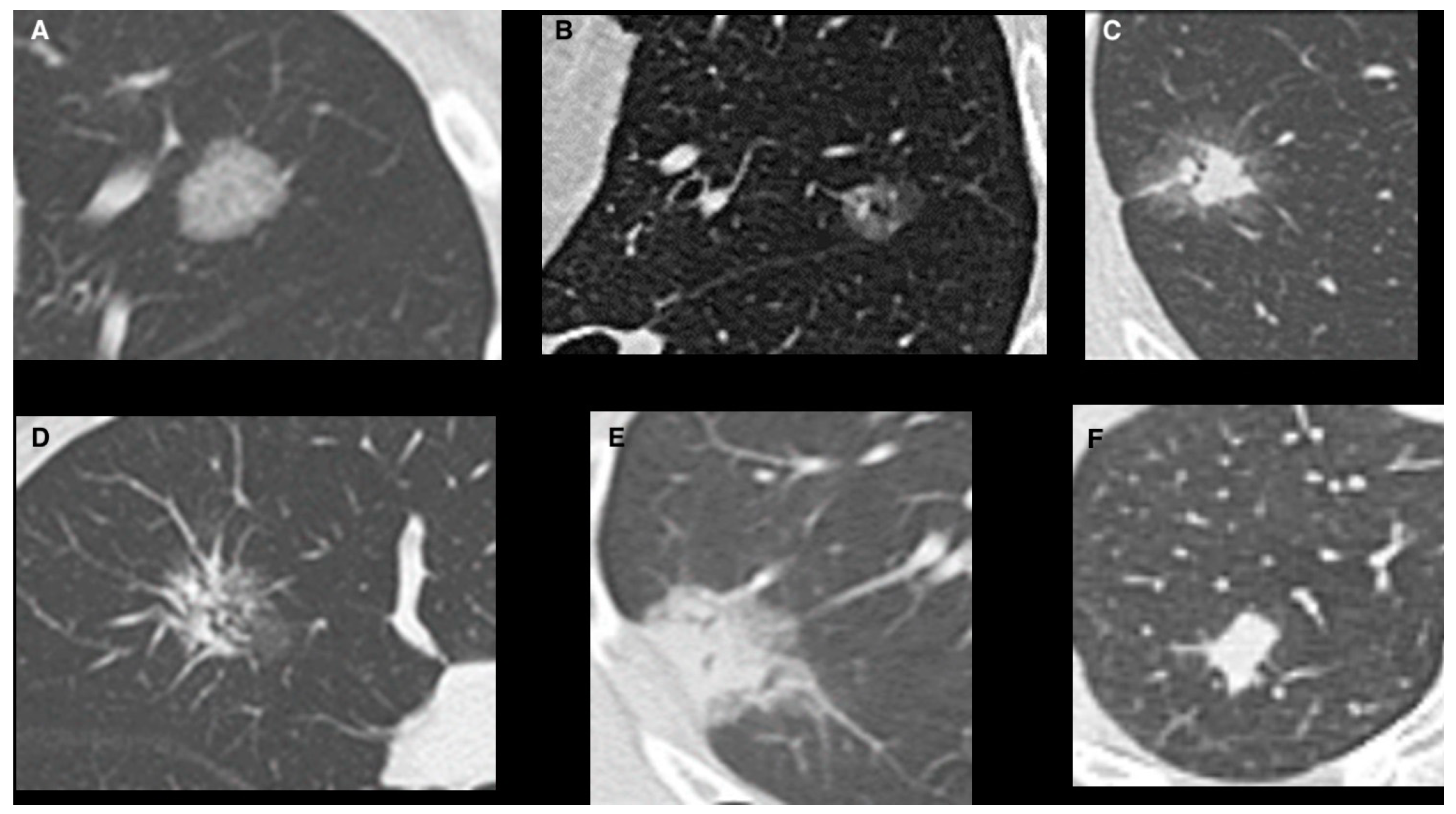 JPM | Free Full-Text | Prognostic Factors of Non-Predominant-Lepidic ...