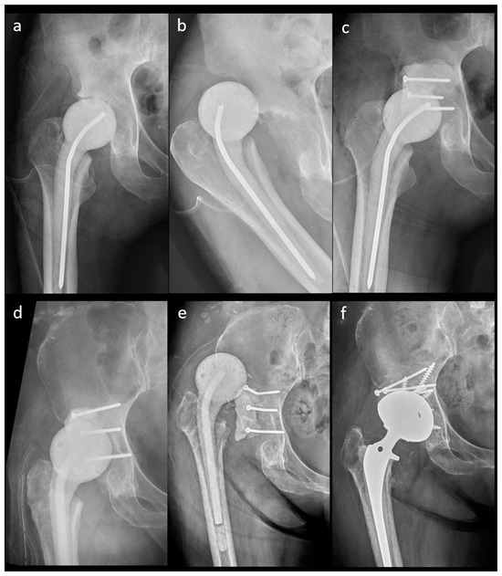 JPM Free FullText MedullarySparing Antibiotic Cement Articulating
