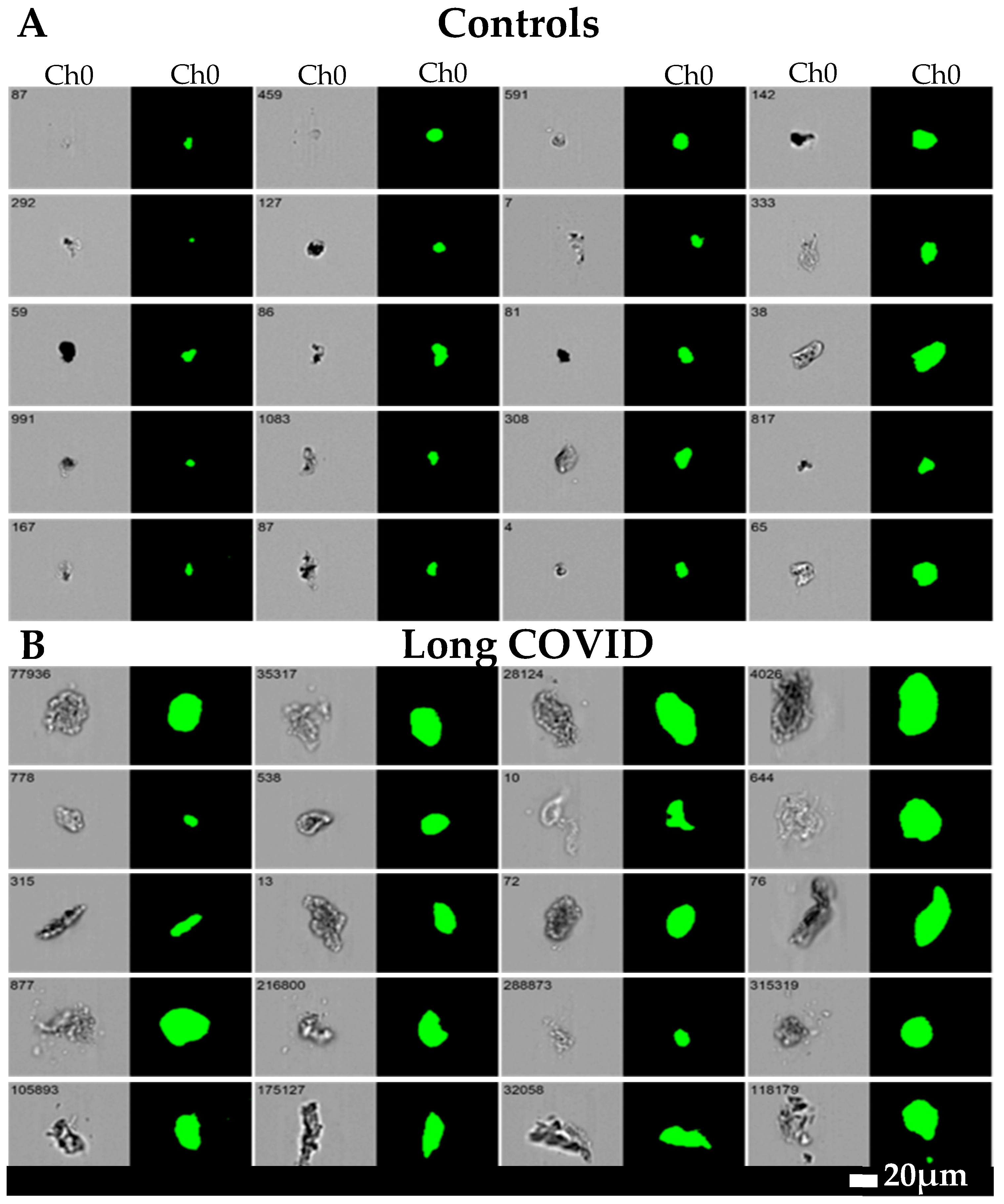 Possible Role of Fibrinaloid Microclots in Postural