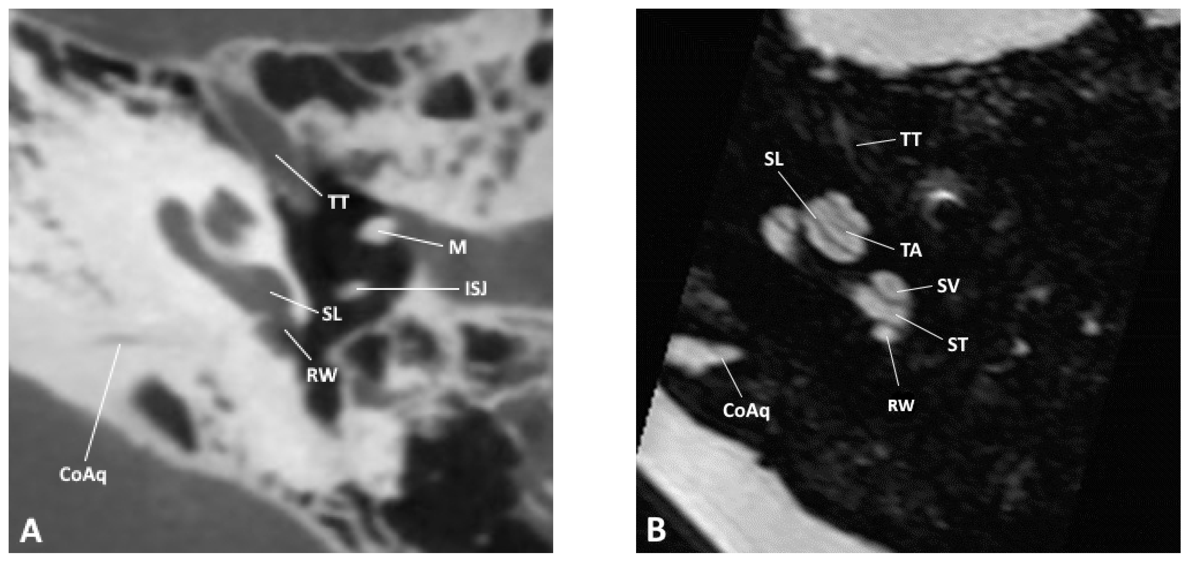 pyramidal eminence ct