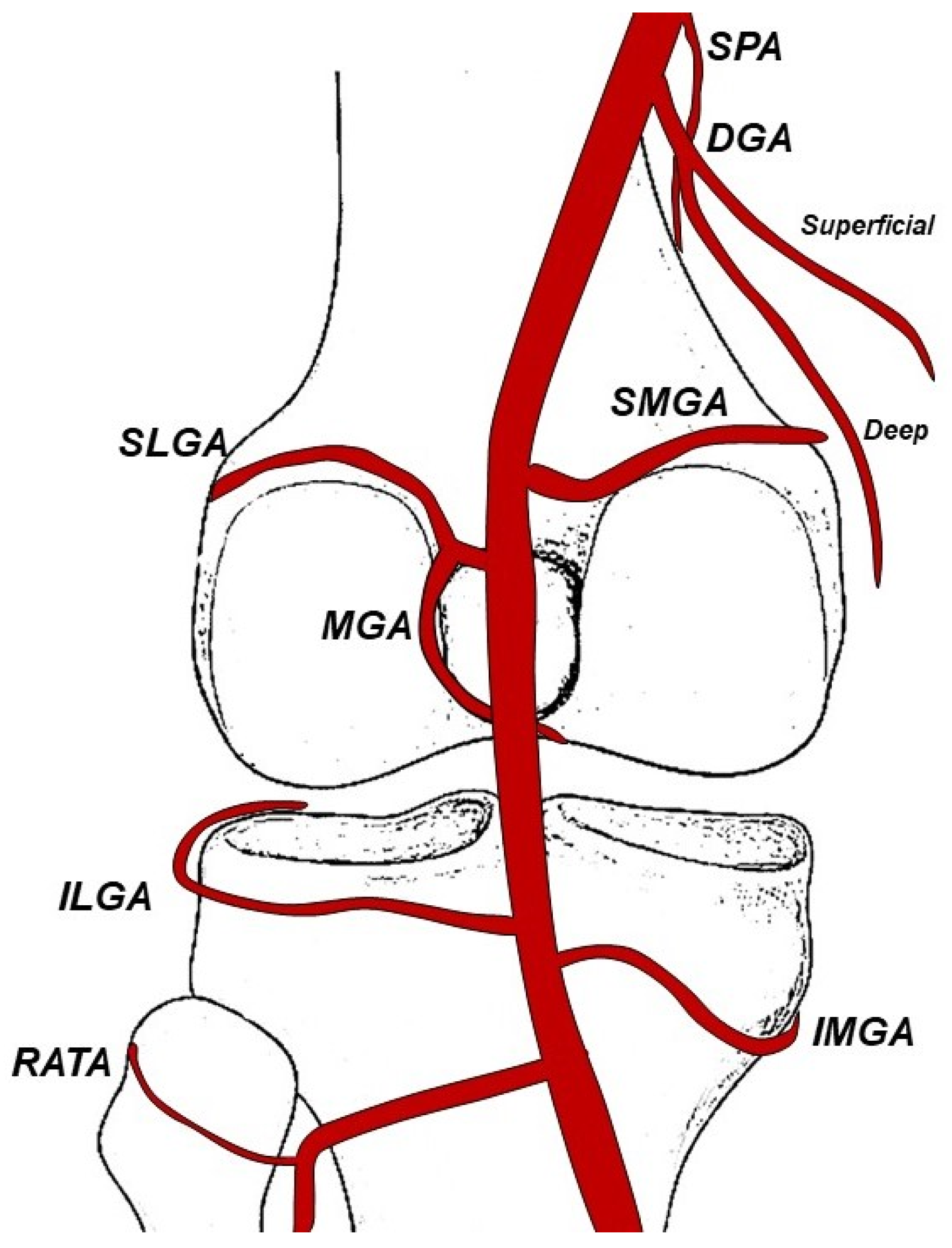 JPM | Free Full-Text | Genicular Artery Embolization: A New Tool for ...