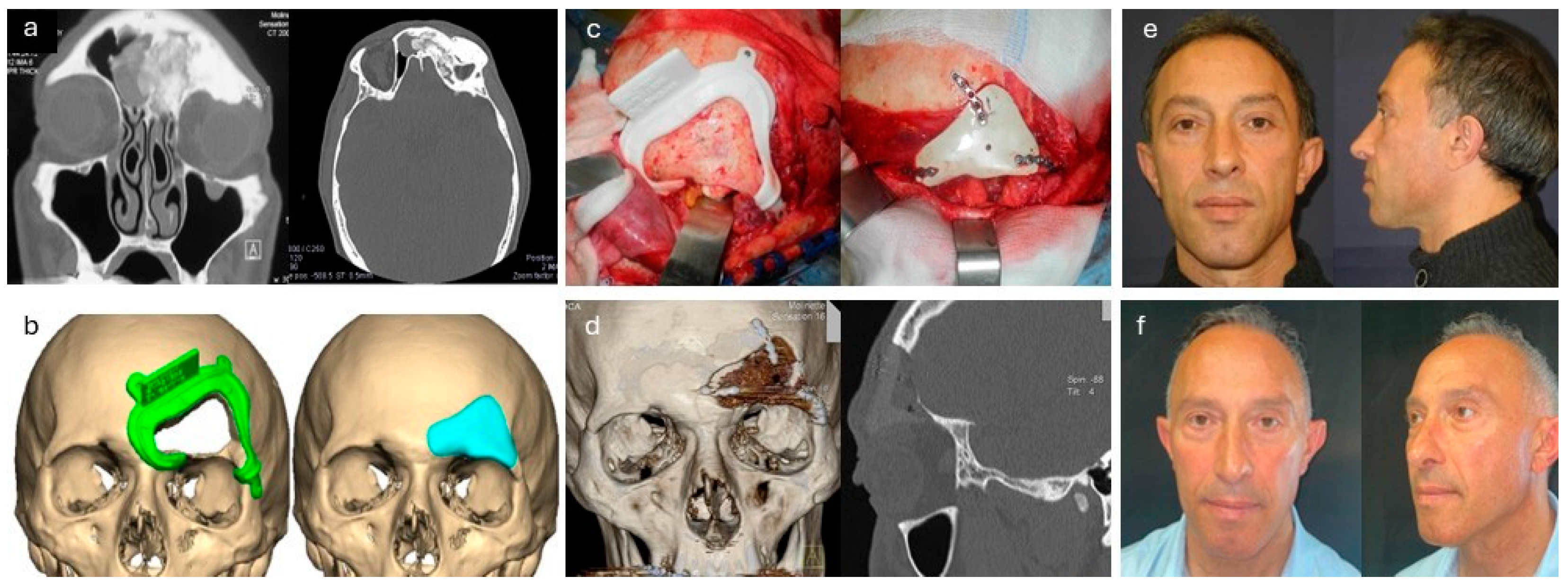 お値下げ相談可能！MAXILLA-ORIENTED IMPLANTOLOGY Remote Anchorage Solutions for Severe Maxillary Atrophy