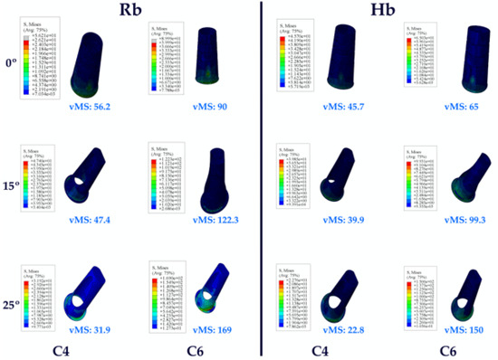 Assessment of the Impact of Bone Quality and Abutment