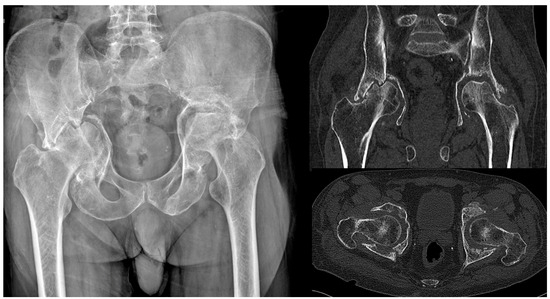 Management of Acetabular Fractures with Total Hip Replacement: A