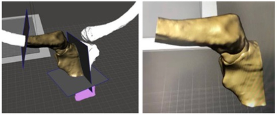 3D Printing and Virtual Surgical Planning in Craniofacial and Thoracic ...