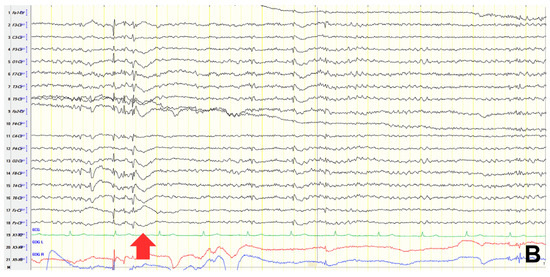 Bridging Epilepsy and Cognitive Impairment: Insights from EEG and