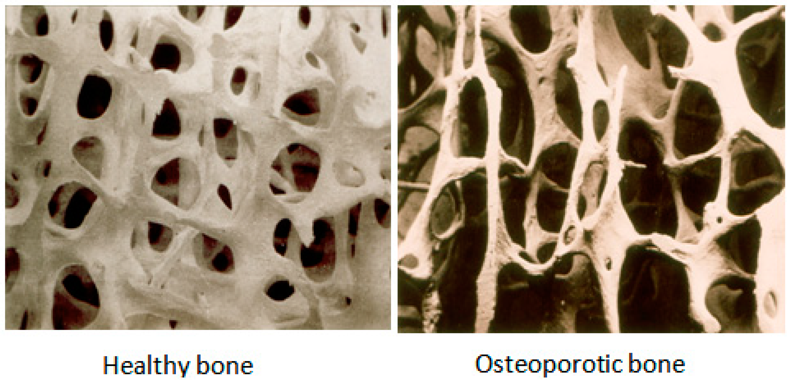 Увеличение плотно. Остеомаляция остеопороз костной ткани. Кость под микроскопом.