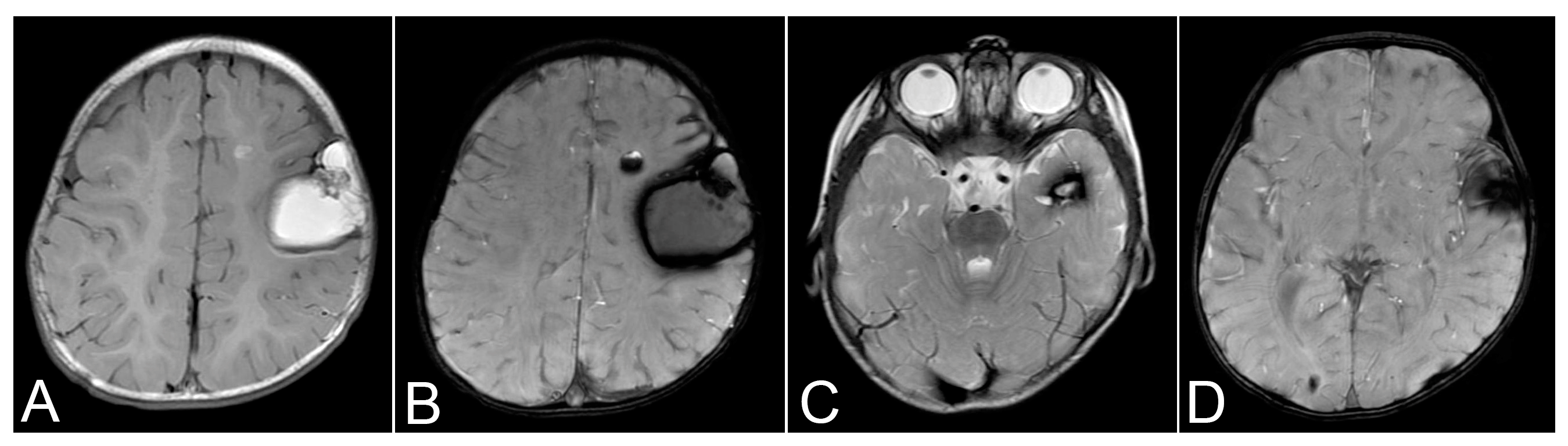 A Novel CCM3 Mutation Associated with a Severe Clinical