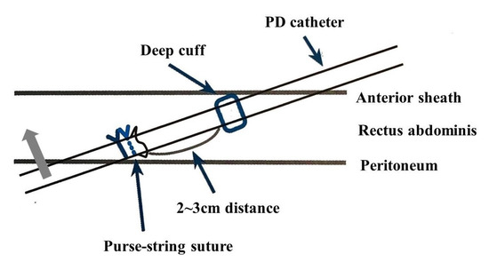 Suture Wire Uses, Sizes & Surgical Techniques • Vast Ortho