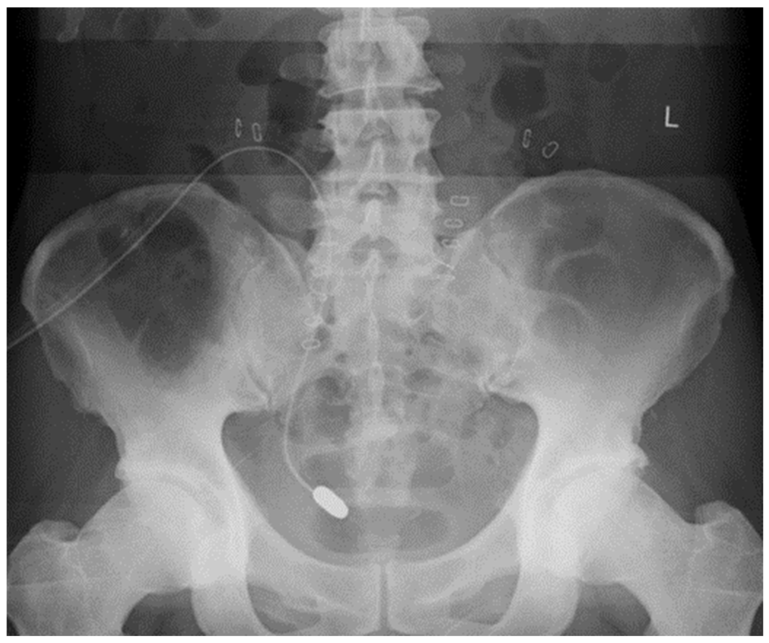 peritoneal-dialysis-catheter-x-ray
